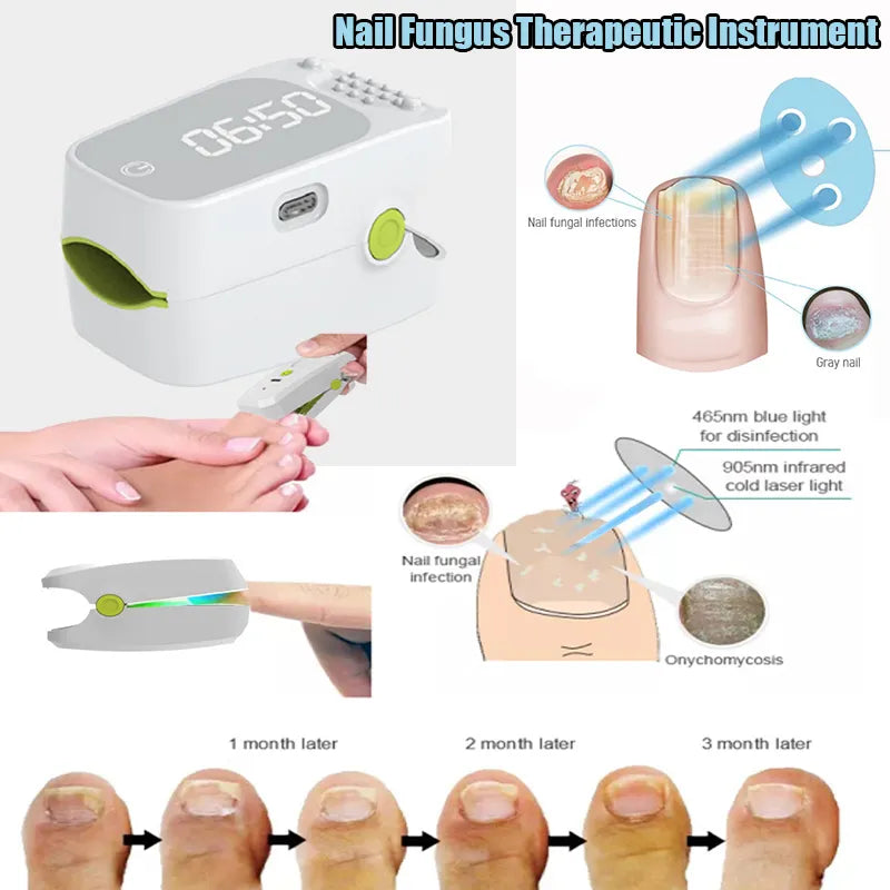 Nail Fungus Laser Therapy Device For NailCare